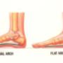Flat Feet