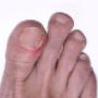 Ingrown Toe Nail
