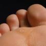 Plantar Warts