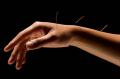 BENEFITS OF ACUPUNCTURE IN ADELAIDE