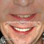 Sydney Composite Veneer