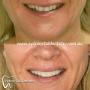 Sydney Veneers