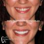 Veneer Sydney