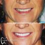 Veneer
