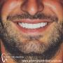 dental veneer Sydney