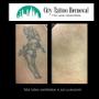 Tattoo Removal Brisbane Before and After