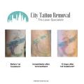 Laser Tattoo Removal