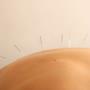 Acupuncture