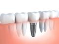 Dental Implants in Collins Street