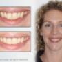 Mt Lawley Invisalign1