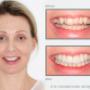 Mt Lawley Teeth Whitening1