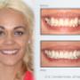 Teeth Whitening Mt Lawley