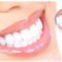 Teeth Whitening