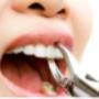 Tooth Extractions