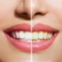 Teeth Whitning