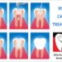 root-canal-treatment