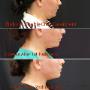 Uploaded by visitor on 15/3/2018 - Double Chin Reduction