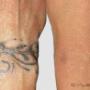 Uploaded by visitor on 15/3/2018 - Tattoo Removal
