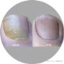 Uploaded by visitor on 16/3/2018 - Laser Nail Fungus treatment Adelaide