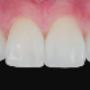 veneers