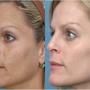 Microdermabrasion
