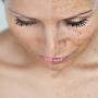 Microdermabrasion