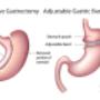 gastric-sleeve-vs-lap-band.png