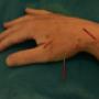 Acupuncture on Hand