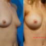 Breast Augmentation