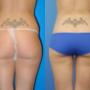 Liposuction