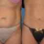 Tummy Tuck