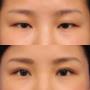 Asian Eye Lift
