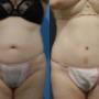Tummy Tuck