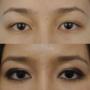 Asian Eye Lift