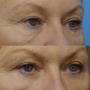 Blepharoplasty