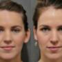 Otoplasty