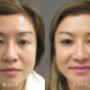 Eyelid Surgery