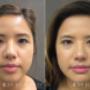 Eyelid Surgery