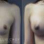 Breast Augmentation