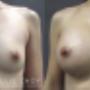 Breast Augmentation