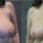 Breast Reduction