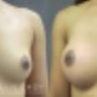 Breast Augmentation