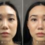 Eyelid Surgery