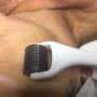 Skin Needling
