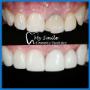 Dental Veneers