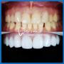 Teeth Whitening
