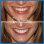 Veneers