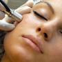 Blackhead removal