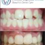 FastBrace