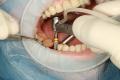 Dental Implants West Perth | West Perth Implants